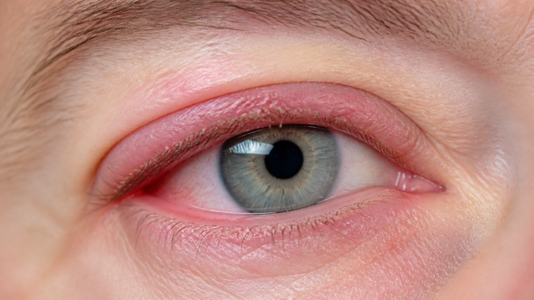 Augenlidentzündung (Blepharitis): Symptome und Behandlung