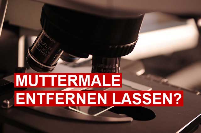 Muttermale entfernen – Ein Ratgeber