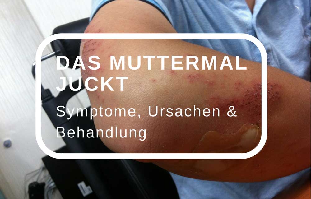 Muttermal juckt und brennt – Ursachen und Behandlung
