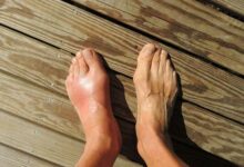 Was tun bei  schmerzhafter Fußgicht?