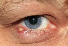 Zyste im Auge: Symptome, Ursachen und Behandlung