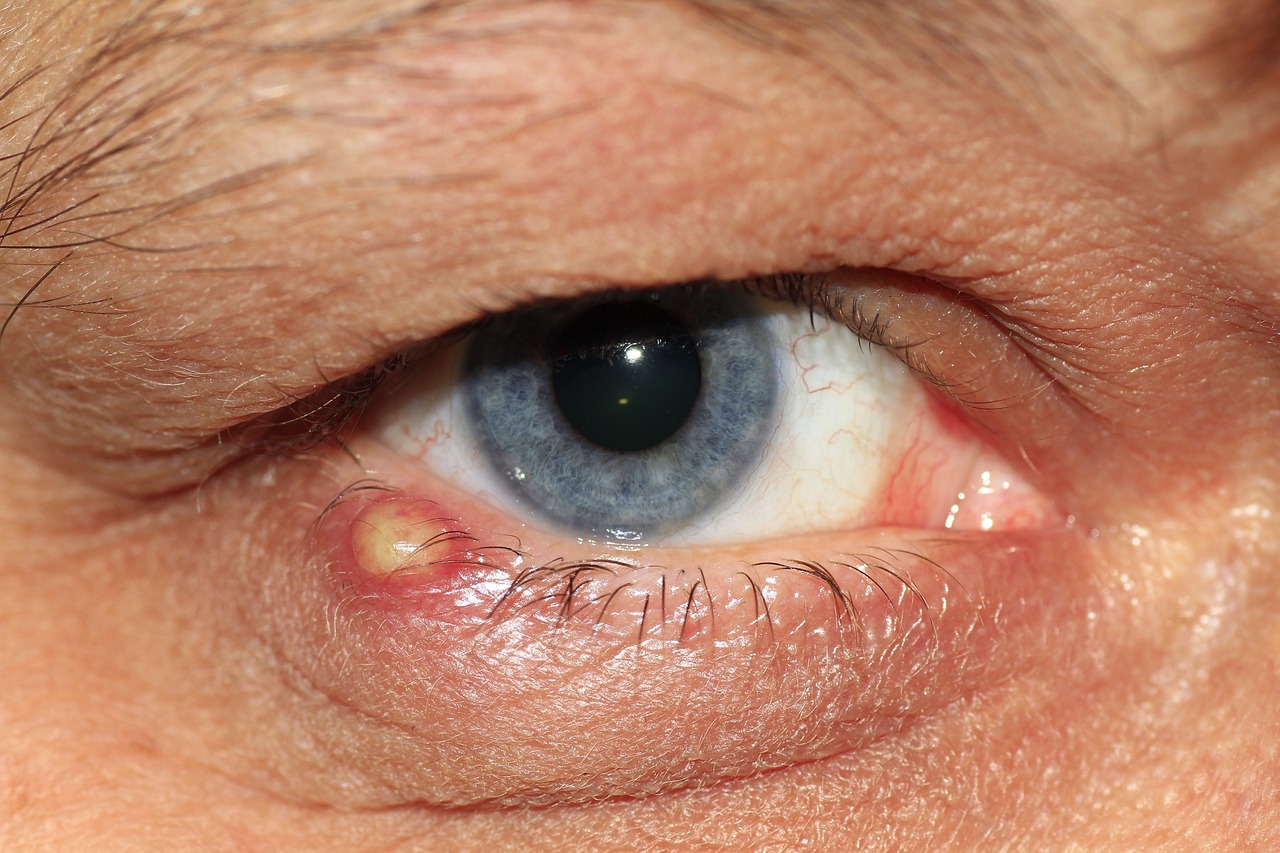 Zyste im Auge: Symptome, Ursachen und Behandlung