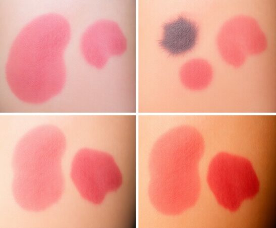 Was sind blaue Flecken? Erkennung von Alter und Farbe von Hautverletzungen