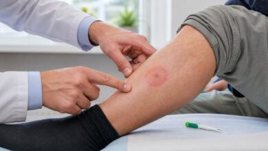 Untersuchung einer möglichen Wanderröte nach Zeckenstich